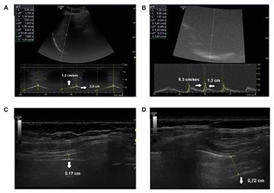 Respiratory Muscle Function Tests and Diaphragm Ultrasound Predict Nocturnal Hypoventilation in Slowly Progressive Myopathies